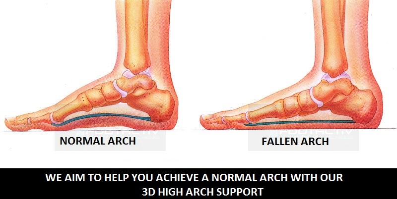 3/4 Plantar Fasciitis Heel Fallen Arches Flat Feet Orthotic Arch ...